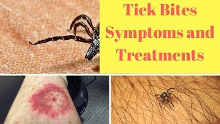 Tick Bites Symptoms and Treatments [upl. by Guttery]