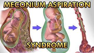 Meconium Aspiration Syndrome Pathophysiology Signs and Symptoms Diagnosis and Treatment [upl. by Aisetal]