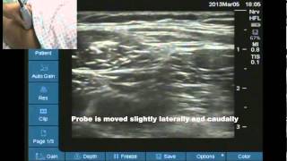 Ultrasound location of lateral femoral cutaneous nerve [upl. by Haskel]