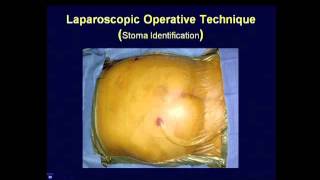 Parastomal Hernia Repair � Best Techniques Kristi Harold MD [upl. by Caitlin623]