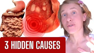 The Hidden Truth What REALLY Causes Gastritis SURPRISE [upl. by Katt]