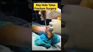 Talus Bone Foot key Hole Surgery  fracture fracturerecovery bone orthopaedic doctorslife acl [upl. by Nali333]