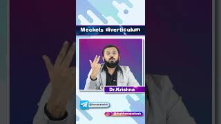 Meckels Diverticulum  Quick Bites [upl. by Jacenta]