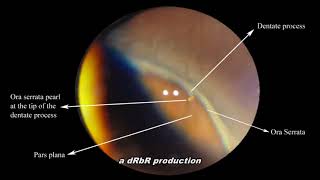 Ora Serrata pearl Scleral depression [upl. by Mcknight]