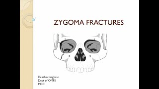 Zygomatic Complex Fracture [upl. by Lierbag]