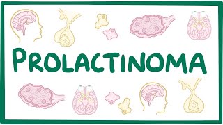 Prolactinoma  causes symptoms diagnosis treatment pathology [upl. by Aihsemat35]