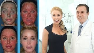 Dr Obagi Blue Peel  Amazing Before and After Results  AntiAging Skincare Over 40 [upl. by Llenral]