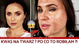 KWASY NA TWARZ  RECENZJA PEELINGU CHEMICZNEGO VLOG [upl. by Billie]