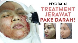 Beberapa Treatment Untuk Hilangkan Bekas Jerawat  Skincare 101 [upl. by Andonis899]