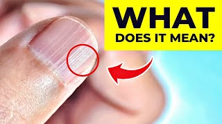 What Do Vertical Ridges On Your Nails Mean The REAL Cause [upl. by Nossila]