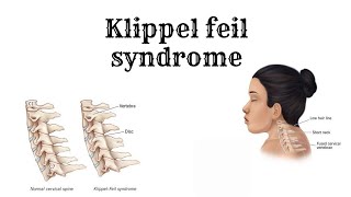 Everything about KLIPPEL FEIL Syndrome [upl. by Arihsak]