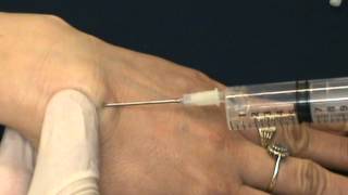 wrist ganglion aspiration [upl. by Lancaster]