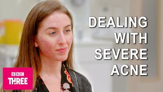 Dealing With Severe Acne Skin [upl. by Anyd591]