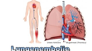 Lungenembolie  Krankheiten der Blutgefäße  Pflege Kanal [upl. by Holleran]