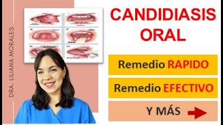 😬3 Remedios naturales para CANDIDIASIS oralesCándida AlbicanscausastratamientoEpisodio 61 [upl. by Kannan77]