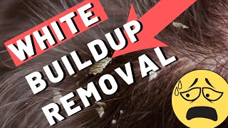 White Buildup on Scalp  How To Remove It [upl. by Retsam536]