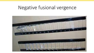 Orthopics series 4  Negative fusional vergence NFV [upl. by Maurilla43]