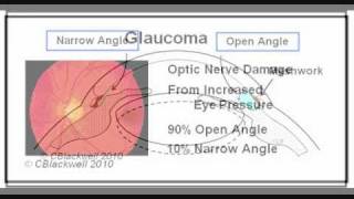 Glaucoma 3 Narrow Angle [upl. by Nortna]