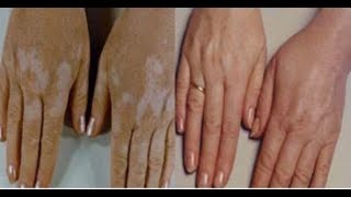 SedefVitiligo ve Cilt Hastalıklarına Okunacak Ayeti Kerim  Kayıp Dualar [upl. by Ormiston]