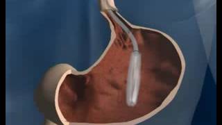 heliosphere Intragastric balloon for weight loss [upl. by Cyndia]