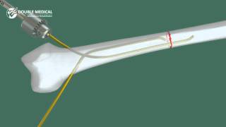 Video Operation of Titanium Elastic Nail [upl. by Ayahsal]