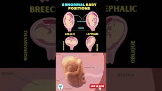 ❤️❤️Understanding Abnormal Baby Positions  Pregnancy positions  Baby position in womb shortsfeed [upl. by Nare]