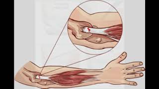 EPICONDILITIS CAUSAS SÍNTOMAS Y TRATAMIENTO  CODO DE TENISTA  CODO DE GOLFISTA [upl. by Stroud841]