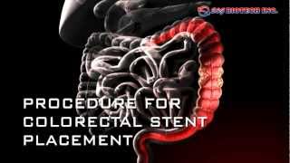 Colorectal Stent [upl. by Yensehc360]