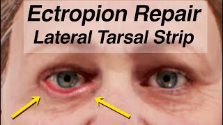 Ectropion Repair Using a Lateral Tarsal Strip Lower Eyelid Drooping After Facial Paralysis [upl. by Sidwohl]