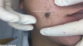 Removing Years Old Blackheads On a Mans Face Easily SS01E01 [upl. by Dream]