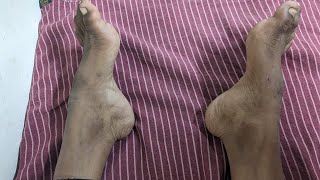 Pes cavus and equinovarus deformities in Neurology DrKamaleshTNMediCalLectures [upl. by Elisa502]