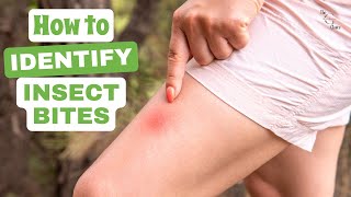 How to Identify Insect Bites A Comprehensive Guide to Recognizing Common Bug Bites [upl. by Ennaylil]