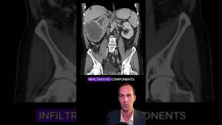 Renal cell carcinoma CT interpretation radiology medicalstudent radiologist radiographer [upl. by Tessie306]