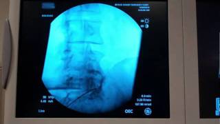 Radio Frequency Ablation Demonstration [upl. by Cissiee]