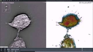 Glioblastoma cells undergoing autophagy observed with holotomographic microscope [upl. by Reifel]