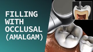 Filling with Occlusal Amalgam [upl. by Ahsekal377]