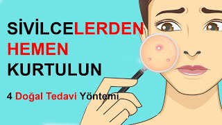 Sivilcelere ne iyi gelir Sivilcelere kesin çözüm [upl. by Afihtan]