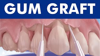 Gum graft  Coronally advanced flap  Receding gums treatment © [upl. by Clercq]