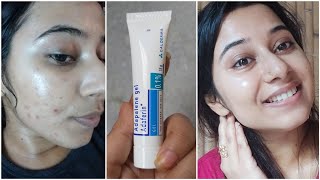 Dermatologist Recommended Best Cream to Remove Pimple Marks Dark spotsPigmentation acne scars [upl. by Seldon]