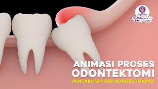 ANIMASI PROSES PENCABUTAN IMPAKSI GIGI BUNGSU  ODONTEKTOMI [upl. by Aubine]