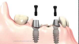 3 unit Bridge on implant abutments [upl. by Ohce90]