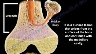 Osteochondroma  solitary and multiple  Everything You Need To Know  Dr Nabil Ebraheim [upl. by Ailat]