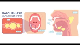 Why formation of calculus  Sialolithiasis is more common in submandibular than in parotid glands [upl. by Tenaej739]