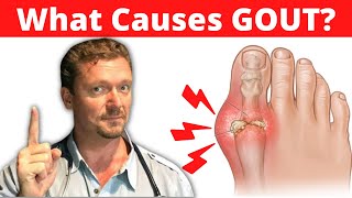 What Causes GOUT Meat Doesnt Cause Gout 2024 [upl. by Panchito]