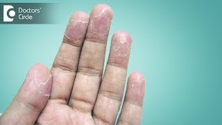 Ways to manage peeling of skin from hands  Dr Sudheendra Udbalker [upl. by Helmut926]