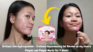 I tried Brilliant Skin Hydroquinone  Tretinoin Rejuvenating Set on my Severe Pimples amp Pimple Marks [upl. by Toffey179]