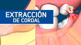 Extracción muela del juicio  Odontoespecialistas [upl. by Aland]