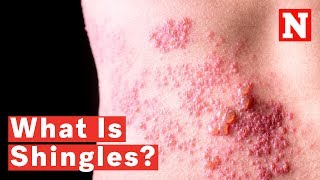 What Is Shingles [upl. by Regnij]