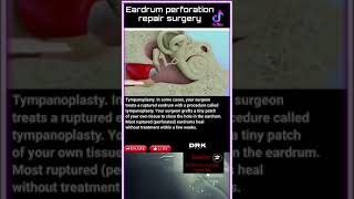 Repair of a perforated eardrum [upl. by Marquis]