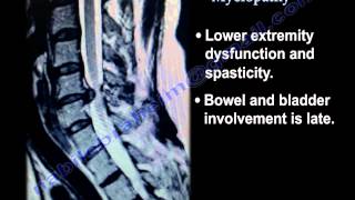 Cervical Spine Myelopathy  Everything You Need To Know  Dr Nabil Ebraheim [upl. by Aelahc]